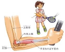 テニス肘　（上腕骨外側上顆炎）