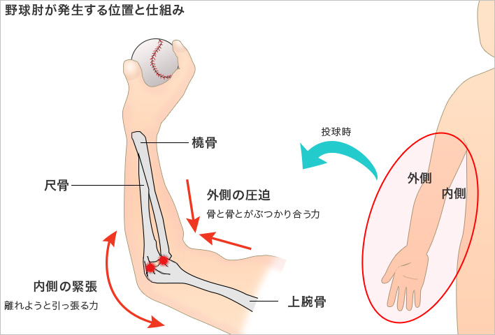 野球肘（離断性骨軟骨炎）