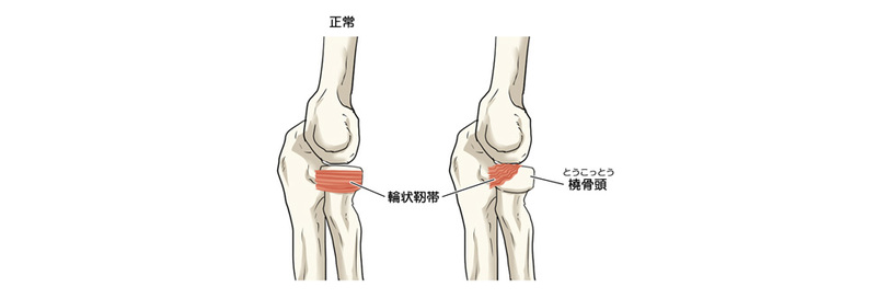 肘内障
