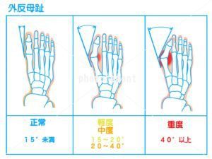 外反母趾