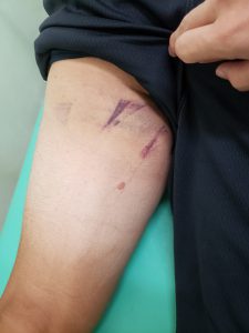 太ももの裏（内側）の肉離れの治療